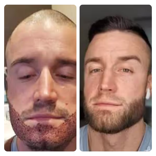 Beard Transplant in Turkey